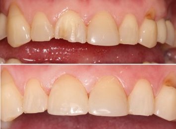 Восстановление зуба путем покрытия цельнокерамической реставрацией (коронкой).